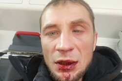 В Киеве жестоко избили ветерана АТО, который борется с застройкой (Фото/Видео)